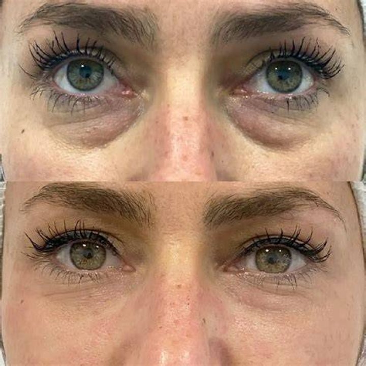 botox under eyes for bags