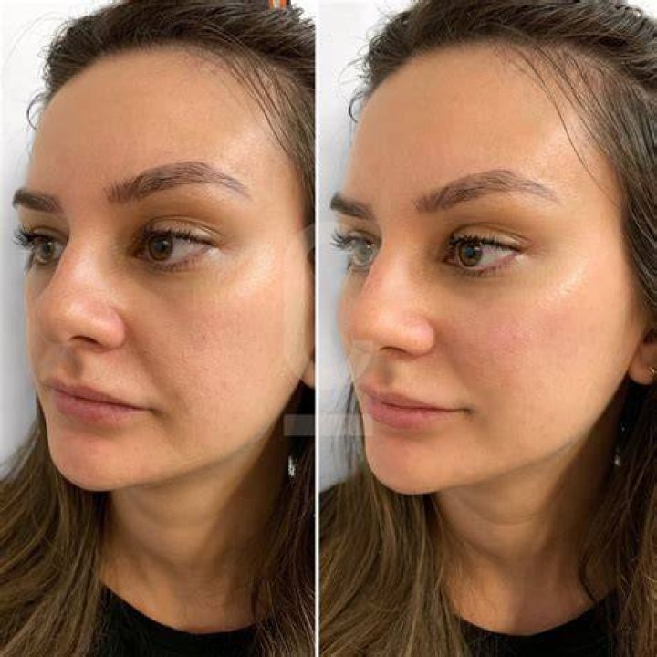 cheek fillers