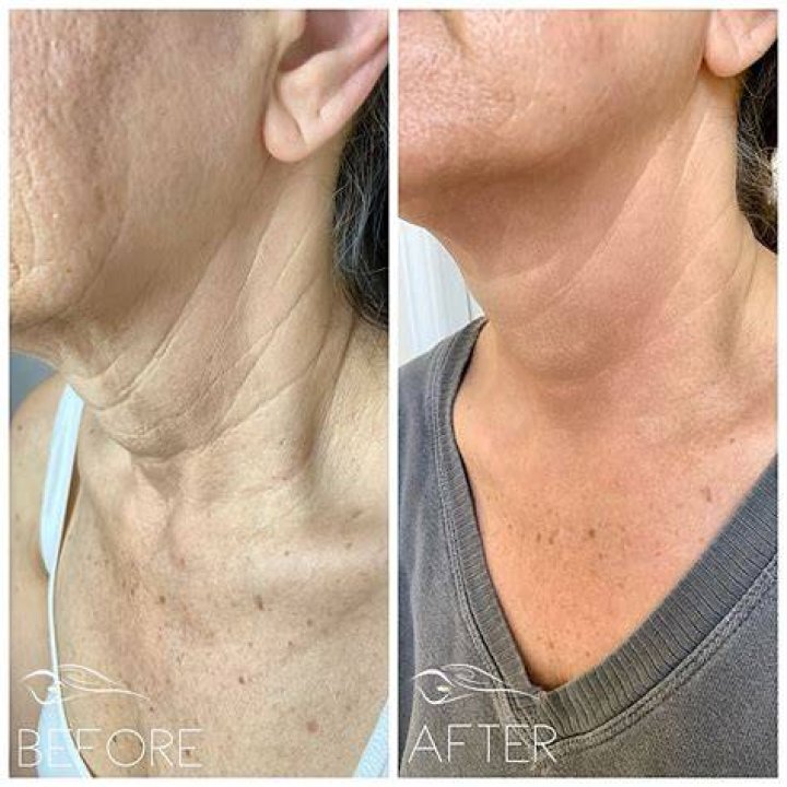 fibroblast therapy