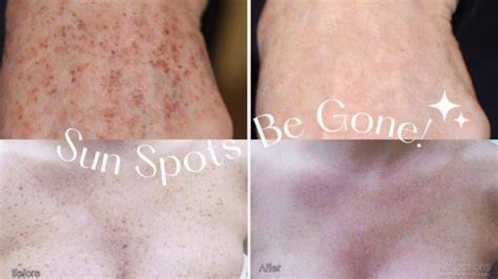 how to remove sun spots on face