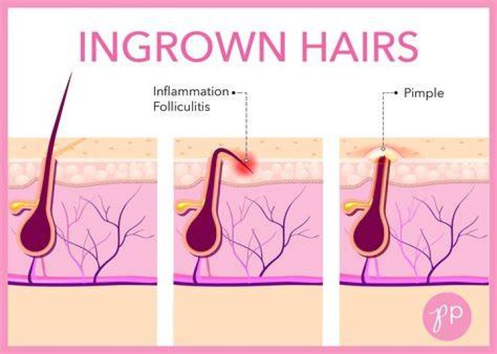 ingrown hair on stomach