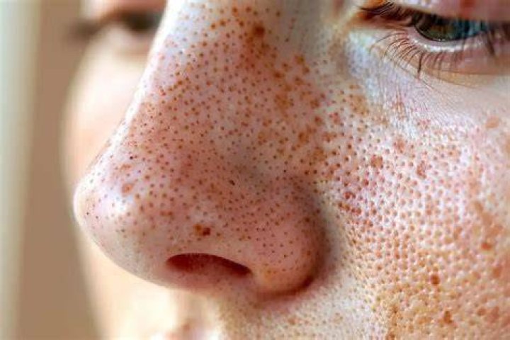 large pores on nose