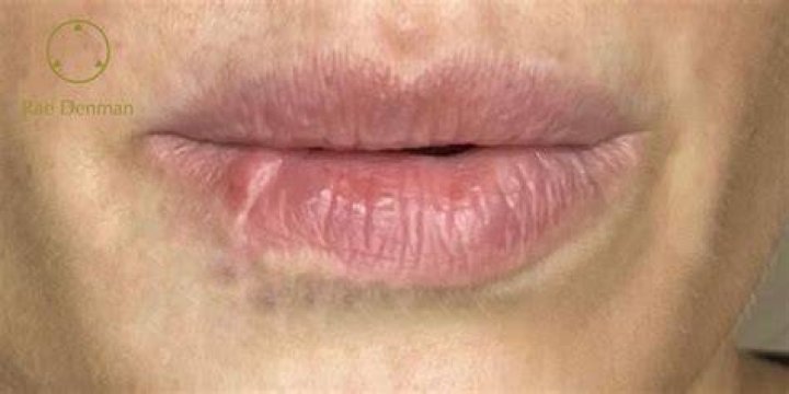 lip scar
