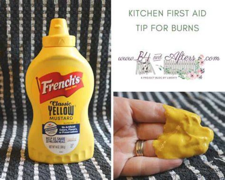 mustard on burns