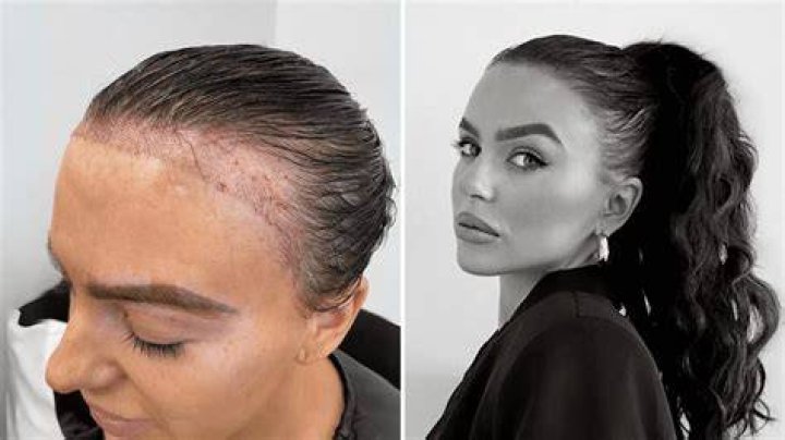 receding hairline treatment