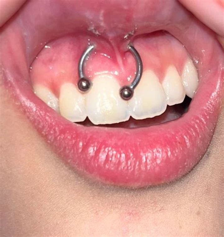 What is smiley piercing? What is smiley piercing?